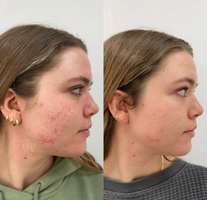 Koreabeauty - Acne buster