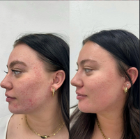 Koreabeauty - Acne buster