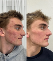 Koreabeauty - Acne buster