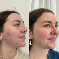 Koreabeauty - Acne buster